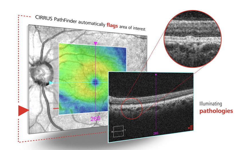 ZEISS innovation paves way to more personalized patient care with cutting-edge AI technology